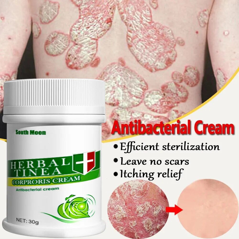 Herbal Psoriasis Cream Treatment Dermatitis Eczema