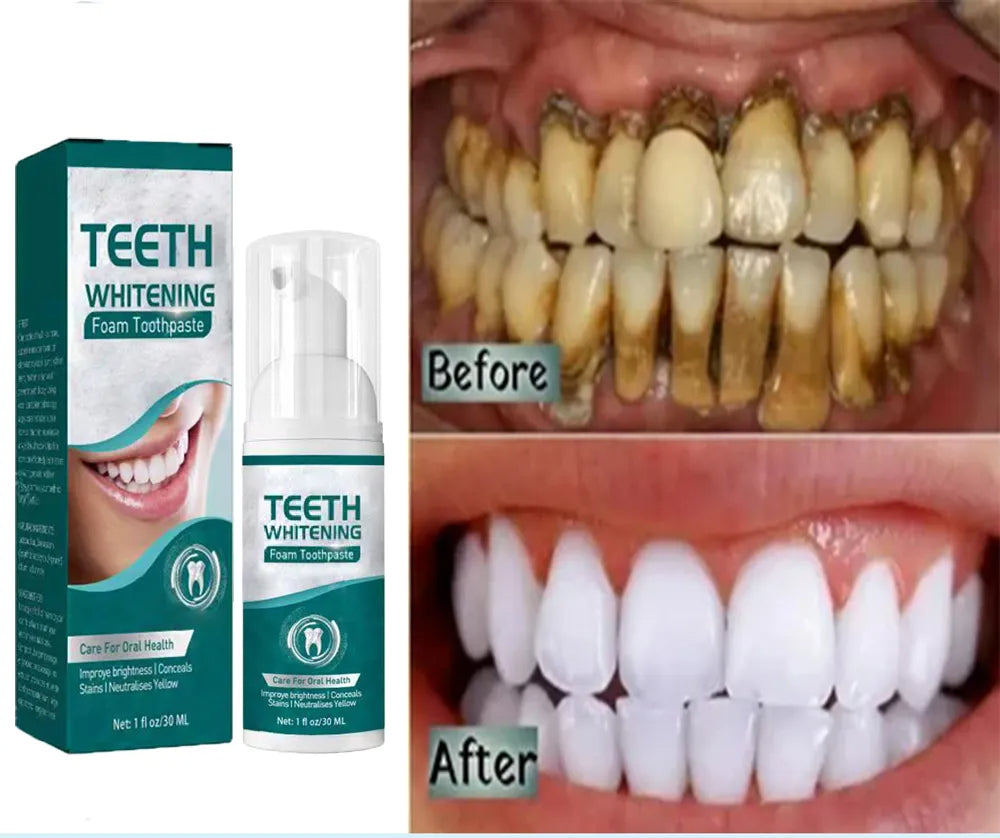 Teeth Whitening Mousse for Dental Health Care