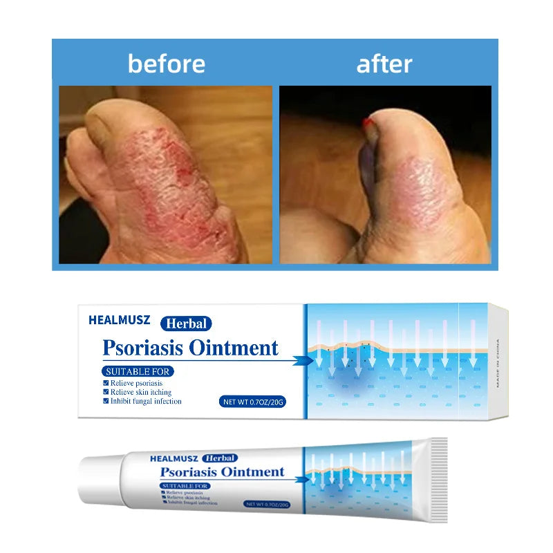 Antibacterial Itch Eczema Relief dermatitis Herbal Skin Psoriasis Cream