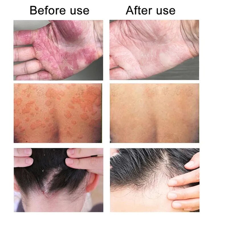 Herbal Psoriasis Cream Treatment Dermatitis Eczema