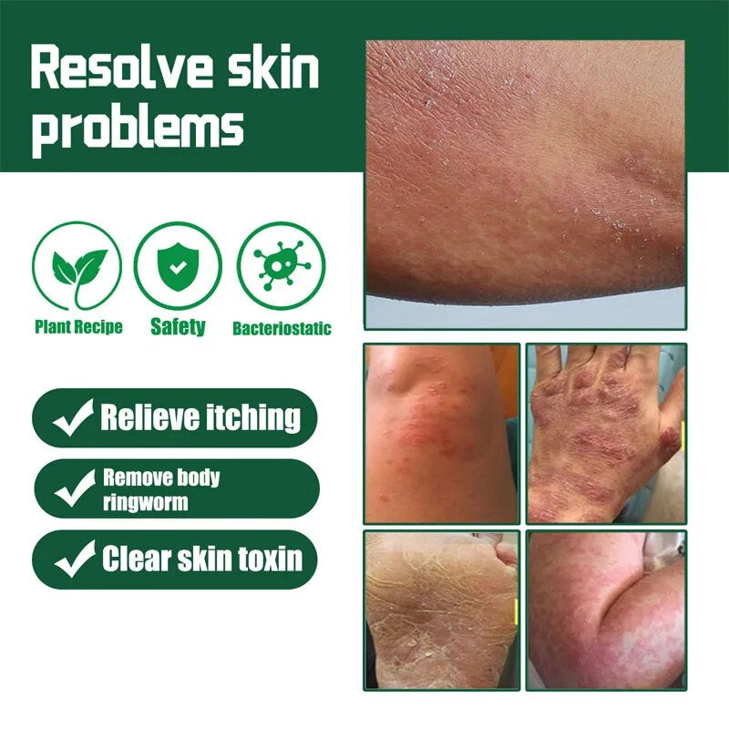 Herbal Psoriasis Cream Treatment Dermatitis Eczema